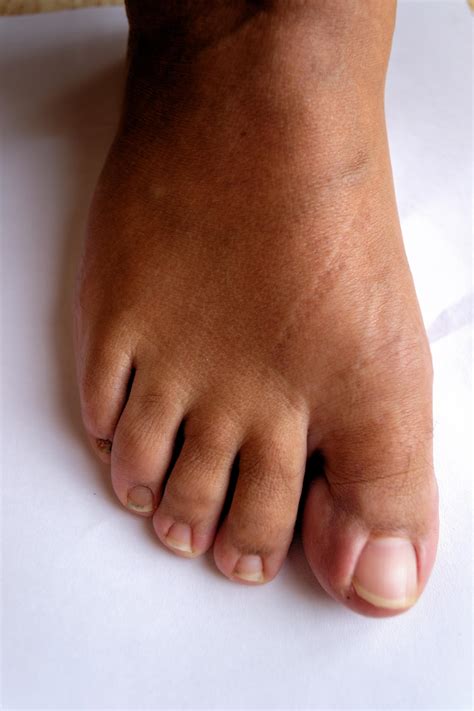 Hallux Rigidus