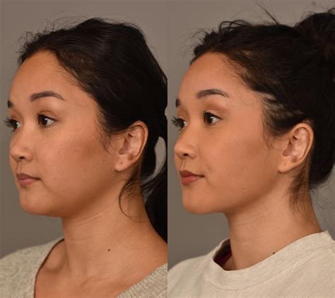 Facial Contouring- Buccal Fat Removal, Neck/Chin Liposuction, Cheek Liposuction