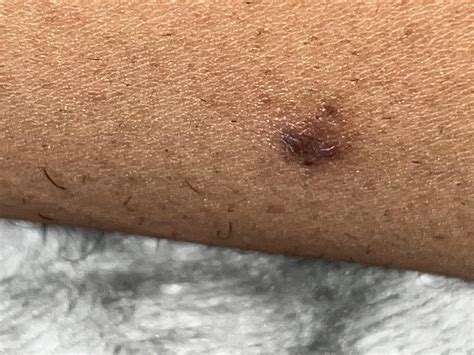 should i be worried about this bump on my inner thigh : r/DermatologyQuestions