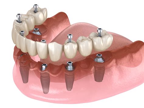 Implant Supported Prosthesis