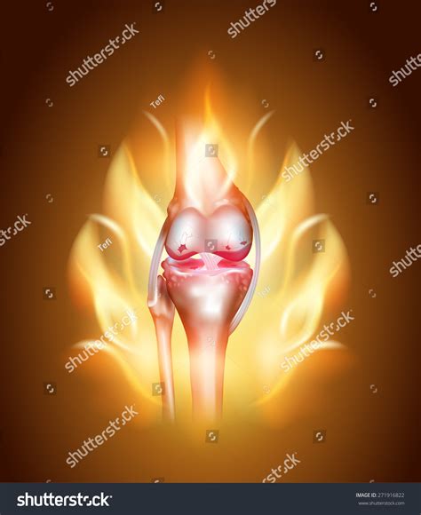 Knee Joint Pain Concept Burning Knee Stock Vector (Royalty Free) 271916822 | Shutterstock