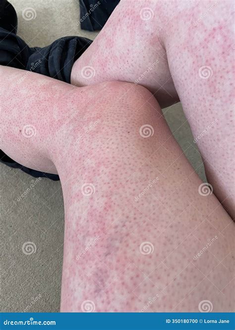 Mottled Skin Heat Rash Hives Allergy Knee Close-up Blotchy Mottled Red ...