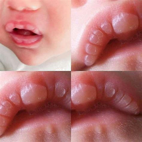 Pinterest | Baby lips, Blister on lip, Baby love