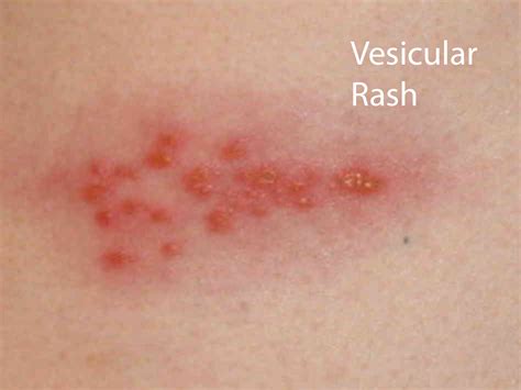 Shingles Rashes Pictures _ What Shingles Look Like – IRMT