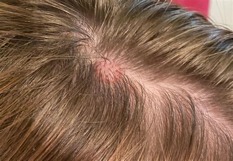 please help!! what are these bumps on my head? should i see a dermatologist? i have 3 (pictures ...