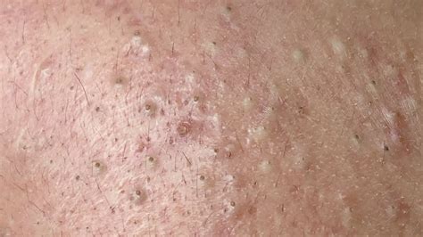 FULL VIDEO Ultimate Blackhead Banishment: Professional Back Extractions ...