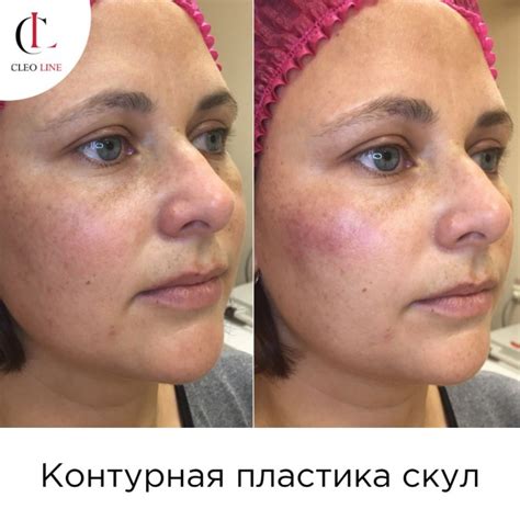 Контурная пластика скул филлерами: отзывы, фото до и после, цена, препараты