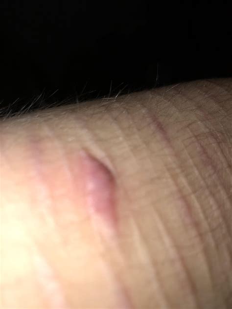 TW SH One of my scars has become really bulgy, the scar in itself is ...