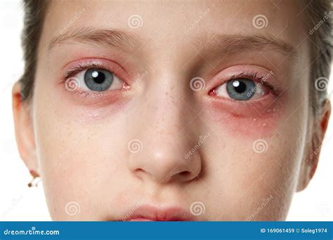 Allergy Bumps On Eyes at Andre Crozier blog