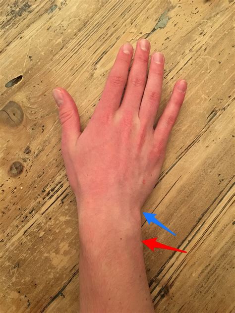 Wrist Pain Pinky Side Swelling at Ricardo Watkins blog