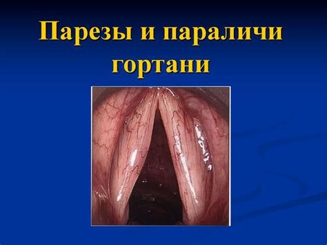 Парезы и параличи гортани - презентация онлайн