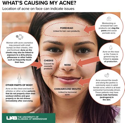 Acne on the cheeks in women: causes and how to get rid of it - Healthy Food Near Me
