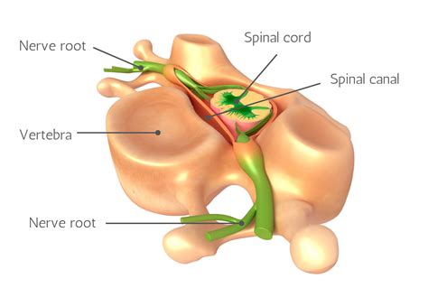 Myelopathy vs Radiculopathy - What's the Difference?