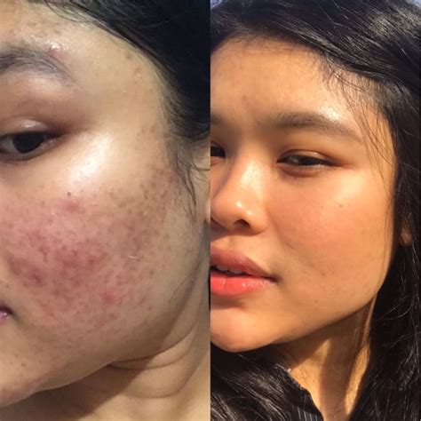 Cerave Cleanser Reaction at Louis Mitchell blog
