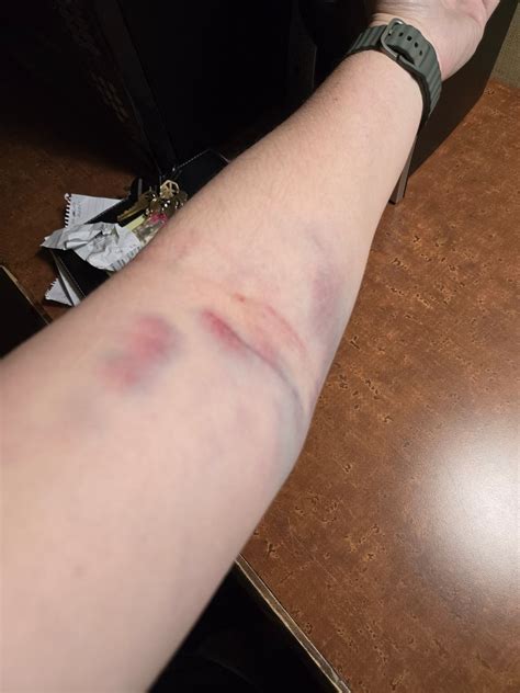 Bruising after plasma donation | BabyCenter