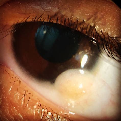 Eye Limbal dermoid | Eye care, Eye care center, Pediatric ophthalmology