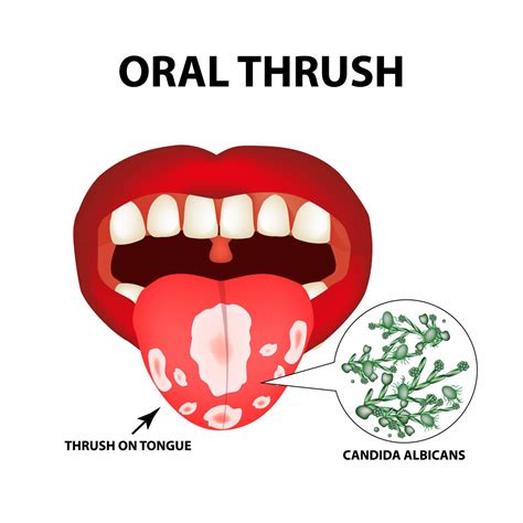 What Is Oral Thrush? | Acorn Dentistry For Kids