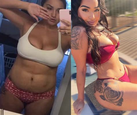 Before & After Plastic Surgery in Miami, FL | Fusion MD