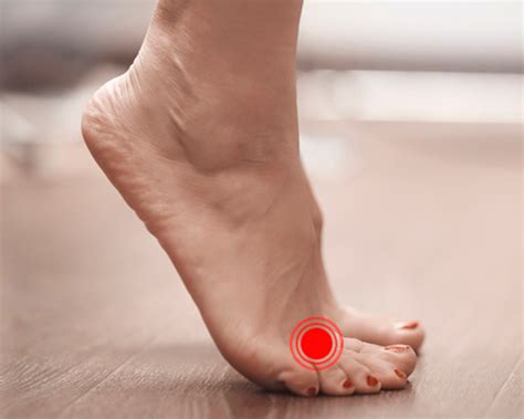 Espolón Calcáneo: Qué Es, Causas, Síntomas Y Tratamiento – QQWLW