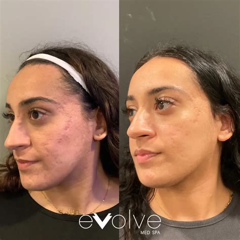Microneedling Acne Scarring Before & After | Evolve Med Spa