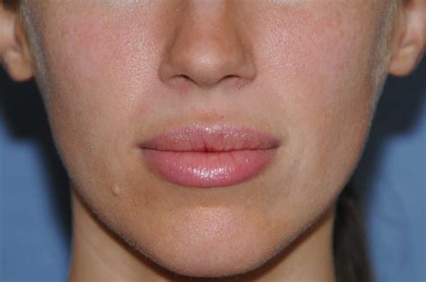 Lip Augmentations with Fat Injections Healing Image Diary