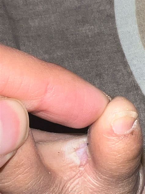 Ask a Dermatologist Online for Skin Peeling Between Pinky Toe