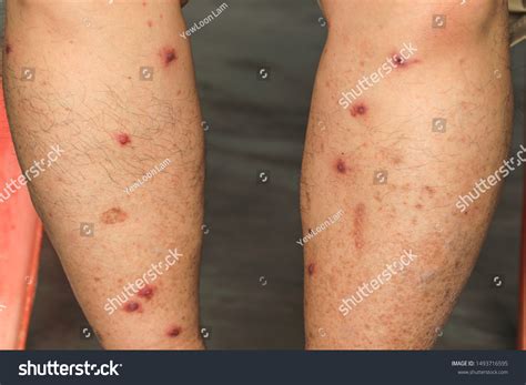 Skinbumpslumpsblisters Caused By Insect Sandfly Bites : photo de stock ...