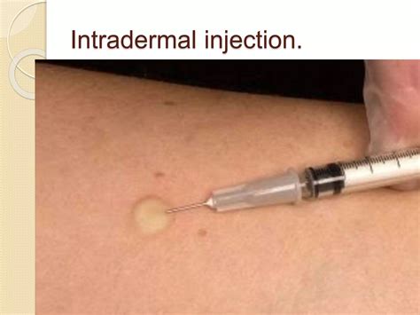 Intradermal injection- Introduction, procedure,complications | PPTX