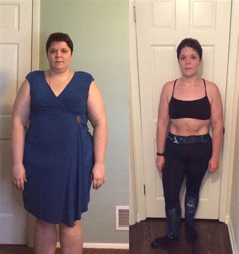15 Wonderful Vsg before and after Sleeve Weight Loss Surgery - Best Product Reviews