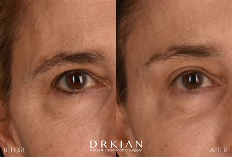Endoscopic Brow Lift Recovery at Sarah Mealmaker blog
