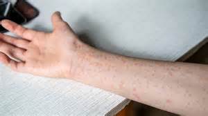 New measles cases, now an outbreak, reported in Erie County