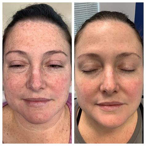 Blue Light Treatment - Red Light Treatment - Blue & Red Light Therapy St. Louis