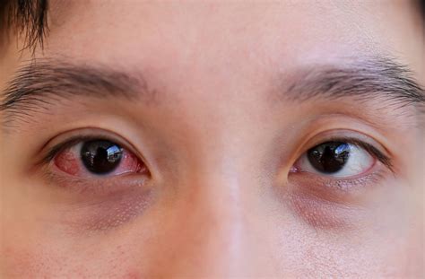 Diseases Of The Eye Daily Mirror Sri Lanka Latest Breaking News And