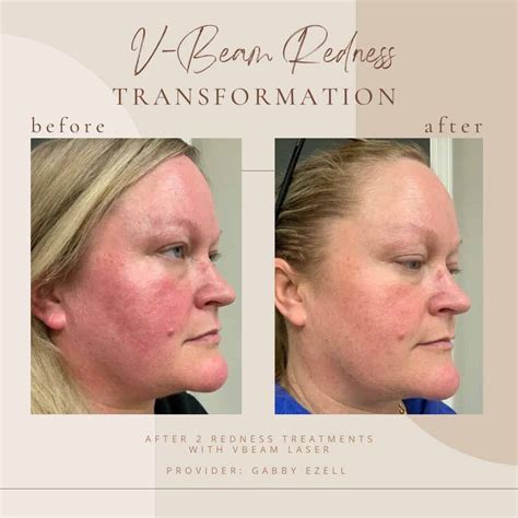 Vbeam Laser Rosacea Before And After - The Best Picture Of Beam