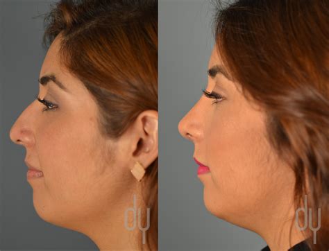 Achieving the perfect button nose shape through rhinoplasty _ nose shapes for men – Akapv