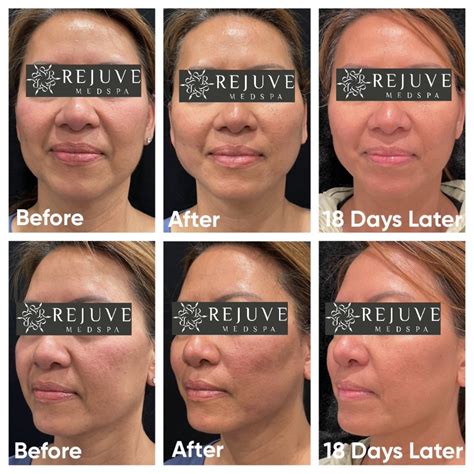 PDO Thread Lift - Instant Nonsurgical Facelift with Threads — Rejuve Medspa | Newcastle near ...