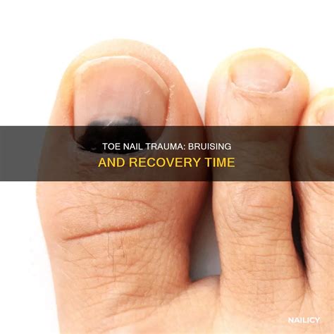Toe Nail Trauma: Bruising And Recovery Time | Nailicy