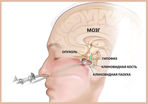 Опухоль гипофиза: первые симптомы и тактика лечения в зависимости от ...