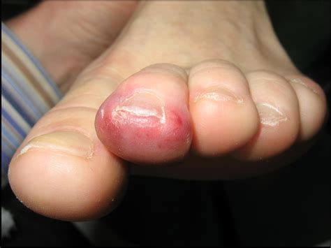 Isolated Blue Toe Syndrome as the Initial Sign of Wegener Granulomatosis - The American Journal ...