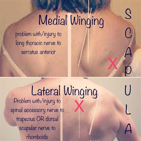 Anatomy Of Scapular Winging