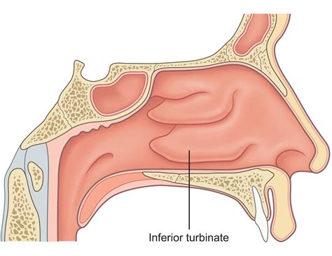 Problems With Turbinate Reduction Surgery – ARKBC