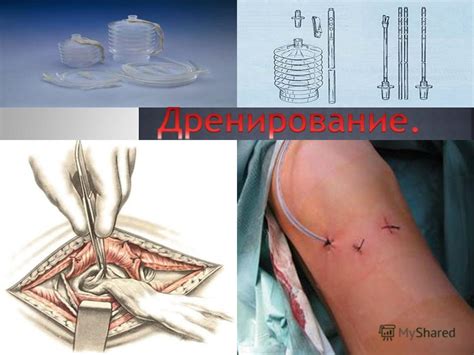 Презентация на тему: "Дренаж - виды дренажей, Показания к дренированию ...