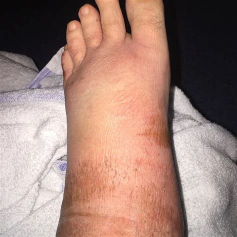 What is Edema? An Easy Guide to Pitting vs. Non-Pitting Edema