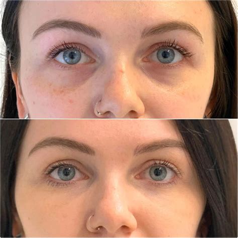 Hollow Under Eyes Top 3 Treatments For Giving Your Eyes A Refreshed