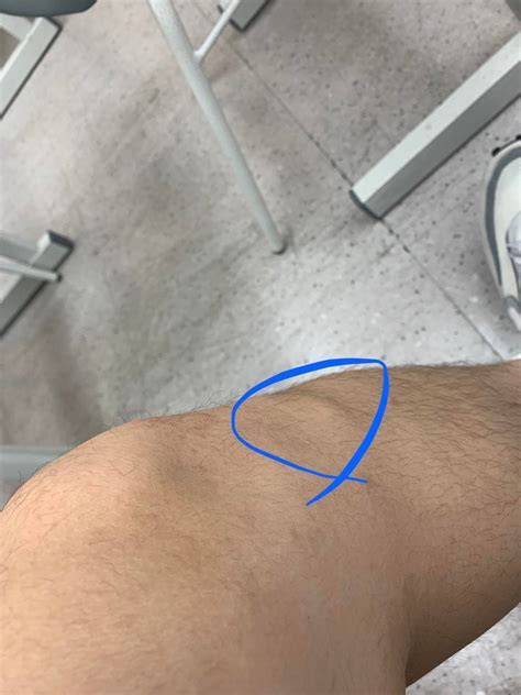 Hard lump (feels like bone) under kneecap. Def not on right leg. Only left, and no pain. I ...