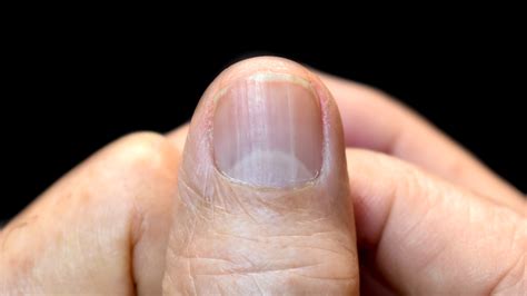 6 Reasons Why You Don't Have Half-Moons (Lunula) on Your Nails - GoodRx