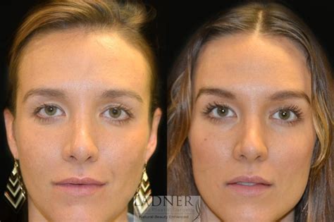 Brow Lift Brow Lift NJ, New Jersey | Spiro Plastic Surgery