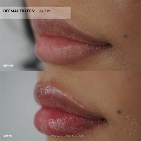 Purple Lips After Lip Fillers - Infoupdate.org
