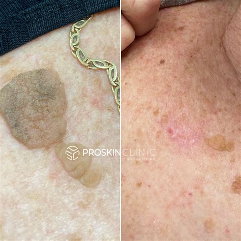 Advanced Lesion Removal Prices - ProSkin Clinic & Health UK