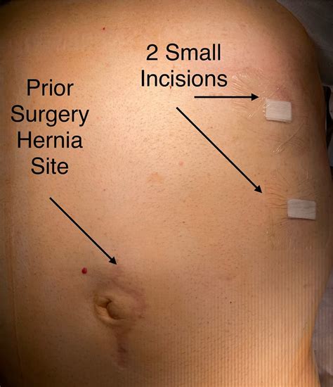 Hernia Watch This Insightful Video On Inguinal Hernia Wherein Dr.